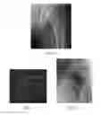 Fig. 12 - Methods of treating degenerative bone conditions