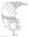 Fig. 13 - NEEDLE PROTECTIVE DEVICE
