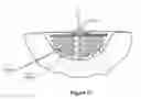 Fig. 19 - Wound dressing apparatus and method of use