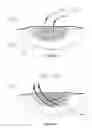 Fig. 27 - Wound dressing apparatus and method of use