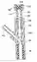 Fig. 01 - Subdural evacuation port aspiration device