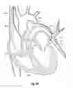 Fig. 11 - STEERABLE SURGICAL SNARE AND METHOD OF USE