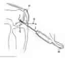 Fig. 01 - System and method for joint resurface repair