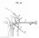 Fig. 08 - System and method for joint resurface repair