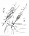 Fig. 10 - System and method for joint resurface repair