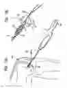 Fig. 15 - System and method for joint resurface repair