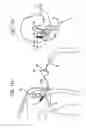 Fig. 16 - System and method for joint resurface repair