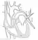 Fig. 01 - Steerable surgical snare