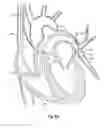 Fig. 10 - Steerable surgical snare