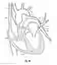 Fig. 11 - Steerable surgical snare