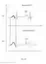 Fig. 151 - Robotic catheter system