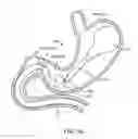 Fig. 02 - Intragastric implant devices