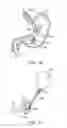 Fig. 03 - Intragastric implant devices