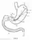 Fig. 05 - Intragastric implant devices