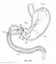Fig. 06 - Intragastric implant devices