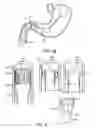 Fig. 07 - Intragastric implant devices
