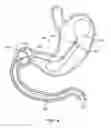 Fig. 09 - Intragastric implant devices