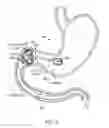 Fig. 10 - Intragastric implant devices