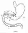 Fig. 11 - Intragastric implant devices