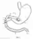 Fig. 12 - Intragastric implant devices