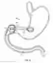 Fig. 13 - Intragastric implant devices
