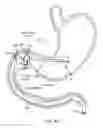 Fig. 14 - Intragastric implant devices
