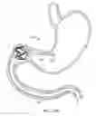 Fig. 16 - Intragastric implant devices