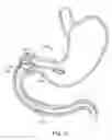 Fig. 19 - Intragastric implant devices