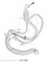 Fig. 22 - Intragastric implant devices