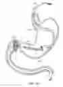 Fig. 23 - Intragastric implant devices