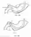 Fig. 24 - Intragastric implant devices