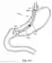 Fig. 25 - Intragastric implant devices
