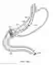 Fig. 26 - Intragastric implant devices