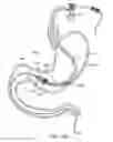 Fig. 27 - Intragastric implant devices