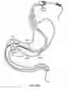 Fig. 28 - Intragastric implant devices