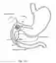 Fig. 30 - Intragastric implant devices