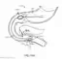 Fig. 31 - Intragastric implant devices