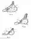 Fig. 02 - TISSUE-ACQUISITION AND FASTENING DEVICES AND METHODS