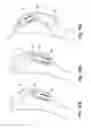 Fig. 08 - TISSUE-ACQUISITION AND FASTENING DEVICES AND METHODS