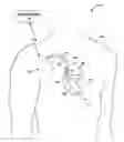 Fig. 01 - Identifying a lead related condition based on motion-based lead impedance fluctuations