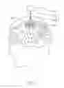 Fig. 02 - Electronic pacemaker and pacemaker lead
