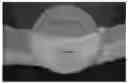 Fig. 01 - PROSTHETIC DEVICE AND METHOD OF USING IN BREAST AUGMENTATION AND/OR BREAST RECONSTRUCTION