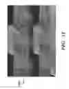 Fig. 18 - PROSTHETIC DEVICE AND METHOD OF USING IN BREAST AUGMENTATION AND/OR BREAST RECONSTRUCTION