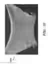 Fig. 19 - PROSTHETIC DEVICE AND METHOD OF USING IN BREAST AUGMENTATION AND/OR BREAST RECONSTRUCTION