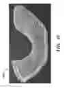 Fig. 20 - PROSTHETIC DEVICE AND METHOD OF USING IN BREAST AUGMENTATION AND/OR BREAST RECONSTRUCTION