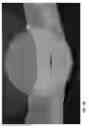 Fig. 30 - PROSTHETIC DEVICE AND METHOD OF USING IN BREAST AUGMENTATION AND/OR BREAST RECONSTRUCTION