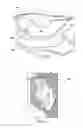 Fig. 13 - Tensioned meniscus prosthetic devices and associated methods