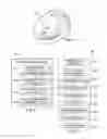 Fig. 14 - Tensioned meniscus prosthetic devices and associated methods