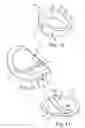 Fig. 08 - MODULAR ARTICULATING PROSTHESES AND ASSOCIATED METHODS