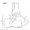 Fig. 02 - Ankle replacement system